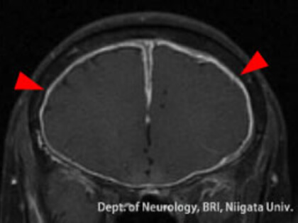 MPO-ANCA陽性肥厚性硬膜炎の頭部MRI画像