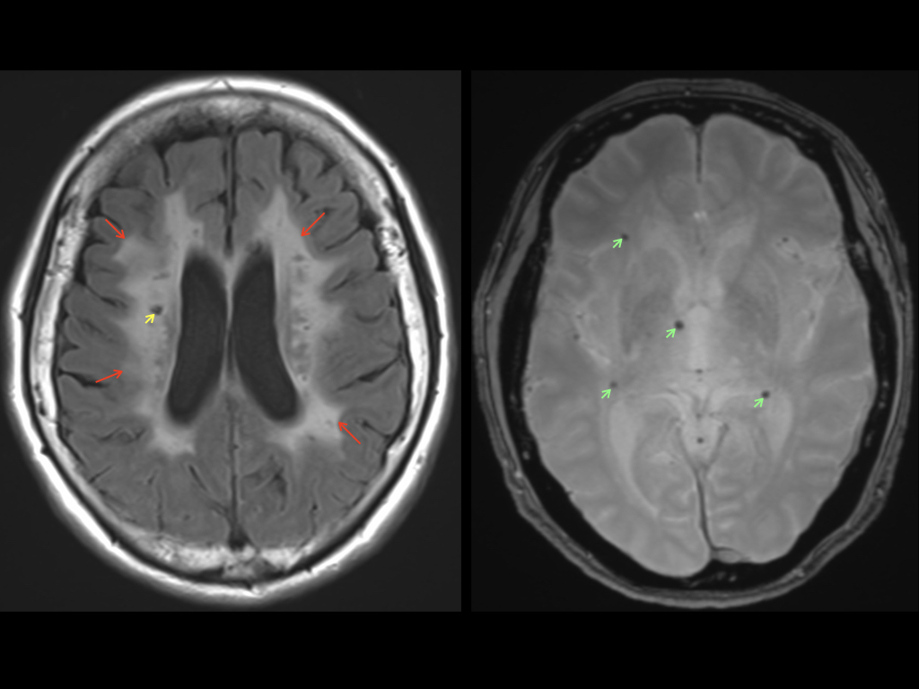 図1. 頭部MRI検査で白質病変（赤矢印）、ラクナ梗塞（黄矢印）、微小出血（緑矢印）を認める。遺伝子解析によりHTRA1の遺伝子変異が認められた。